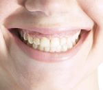 Zahnfüllung Amalgam Quecksilber Amalgam-Zahnfüllungen mit Quecksilber
