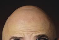 Glatze Haarausfall Therapie